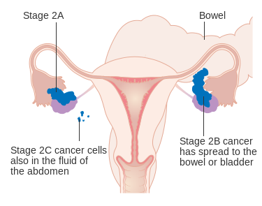 How To Prevent Ovarian Cancer