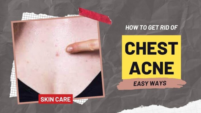 How To Get Rid of Chest Acne