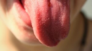 11 Home Remedies For Burning Tongue Syndrome