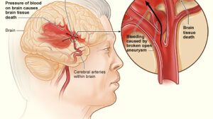 9 Powerful Tips How To Prevent A Stroke