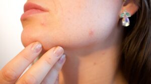 11 Easy Ways How to Prevent Acne