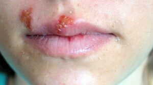 3 Tips – How To Prevent Cold Sores