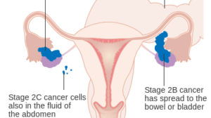 Discover 9 Ways How to Prevent Ovarian Cancer & Take Control of Your Health – Empower Yourself