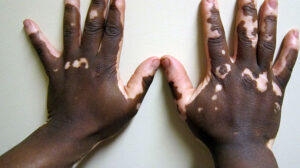 Unlock the Secrets: How To Prevent Vitiligo & Maintain Healthy Skin