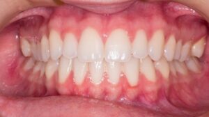 How to Prevent Gingivitis: Expert Tips for Optimal Oral Health