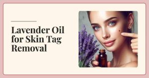 Lavender Oil for Skin Tag Removal: 7 Amazing Benefits and How to Apply It