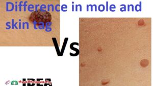 Difference in mole and skin tag