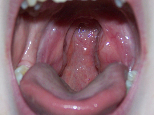 White spot on tonsil