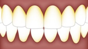 Teeth Have Feelings Too: Plaque – The Smile’s Enemy