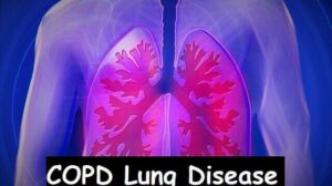 COPD Lung Disease: Causes, Symptoms, Examination, and Prevention