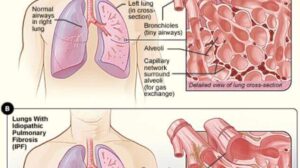 Idiopathic Pulmonary Fibrosis: 5 Symptoms, Causes, and Risk Factors