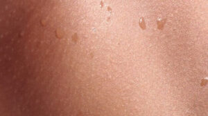 Skin Cancer: 3 Types, Symptoms, and Causes
