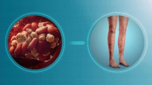 Antiphospholipid Syndrome: 14 Symptoms, Risk Factors, Causes, Diagnosis, and Complications