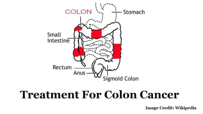 Treatment For Colon Cancer
