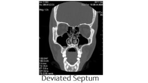 Deviated Septum