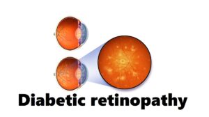 Diabetic Retinopathy: Definition, Causes, 6 Risk Factors, Symptoms, and Diagnosis