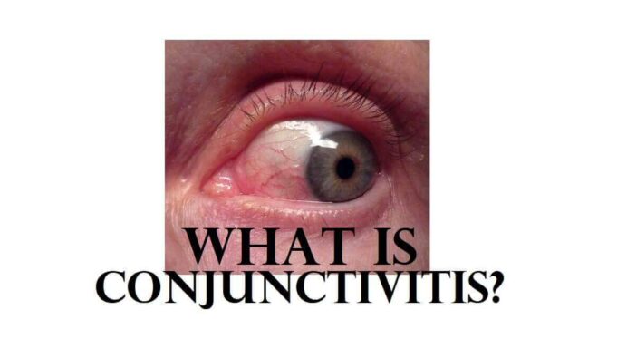 What is Conjunctivitis