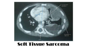 Soft Tissue Sarcoma: 7 Types, Causes, Symptoms, and Diagnosis