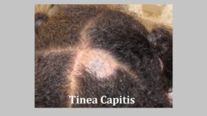 Tinea Capitis: Definition, Symptoms, Risk Factors, Causes, and Diagnosis