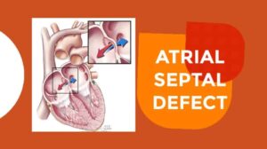 Atrial Septal Defect: Definition, Causes, and Clinical Features / Symptoms