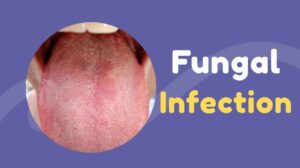 Fungal Infections: 7 Types, Causes, Risk Factors, Symptoms, and Home Remedies