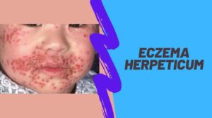 Eczema Herpeticum: Causes, Diagnosis, and Treatment