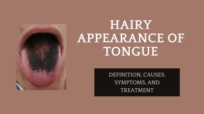 Hairy Appearance of Tongue