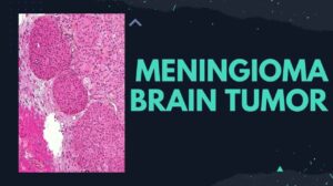 Meningioma Brain Tumor: Causes, Symptoms, Diagnosis, Stages, Treatment, Complications, and Prevention
