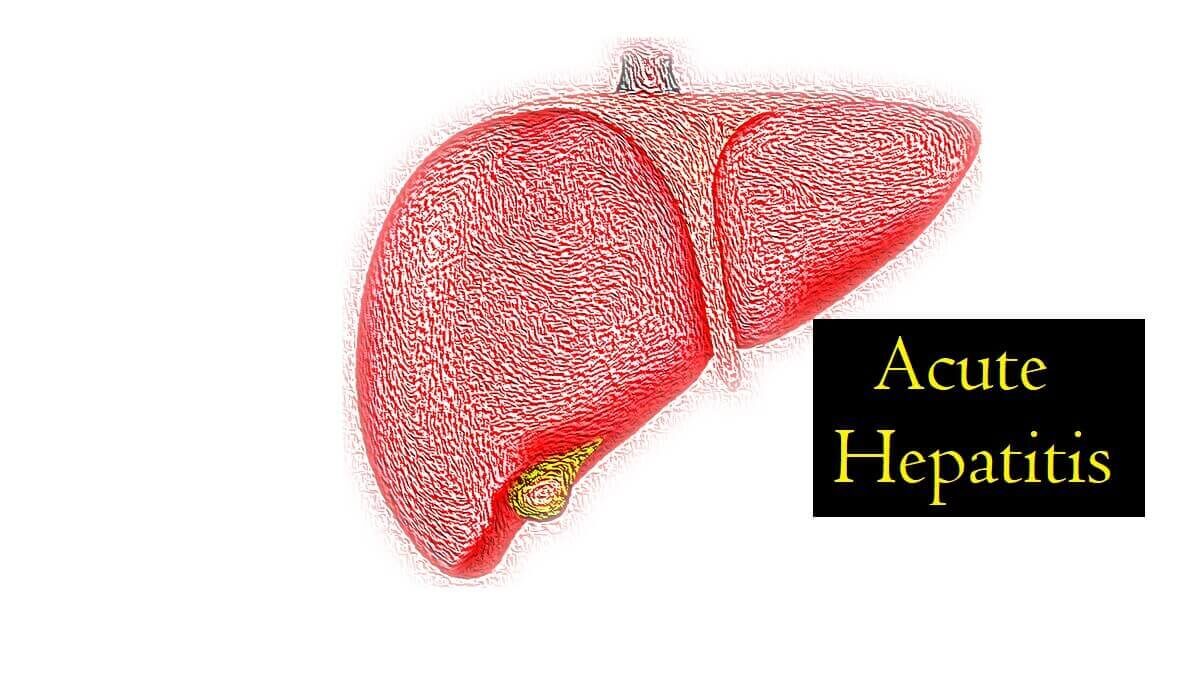 What Is Acute Hepatitis: Causes, Risk Factors, Symptoms, Diagnosis, and Prevention