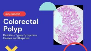 Colorectal Polyp: Definition, Types, Symptoms, Causes, and Diagnosis