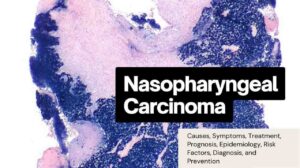 Nasopharyngeal Carcinoma: Causes, Symptoms, Treatment, Prognosis, Epidemiology, Risk Factors, Diagnosis, and Prevention