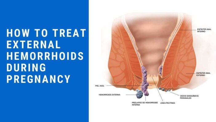 How To Treat External Hemorrhoids During Pregnancy