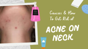 Acne on Neck: 5 Must Know Causes & How To Get Rid of It
