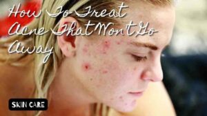 How To Treat Acne That Won't Go Away
