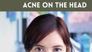 Acne on The Head