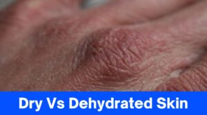 9+ Differences Between Dry Vs Dehydrated Skin, Recognize The Characteristics