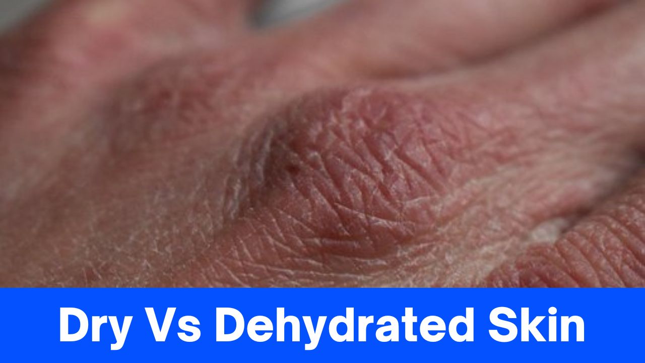 9+ Differences Between Dry Vs Dehydrated Skin, Recognize The Characteristics