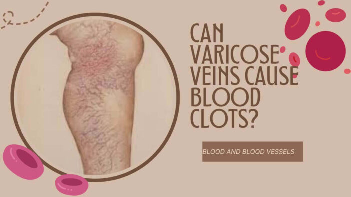 Can Varicose Veins Cause Blood Clots?