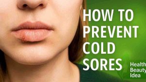 How To Prevent Cold Sores