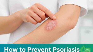 How to Prevent Psoriasis
